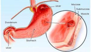 What Are Stomach Ulcers? Its Signals and Causes!