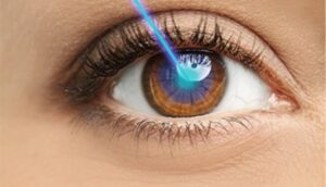 Contact The Expert For Lasik Eye Surgery Los Angele