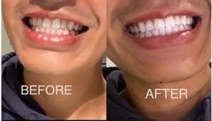 PAP Teeth Whitening Strips: Gentle, Peroxide-Free Kit, 28 Strips, 14 Treatments for Sensitive Teeth